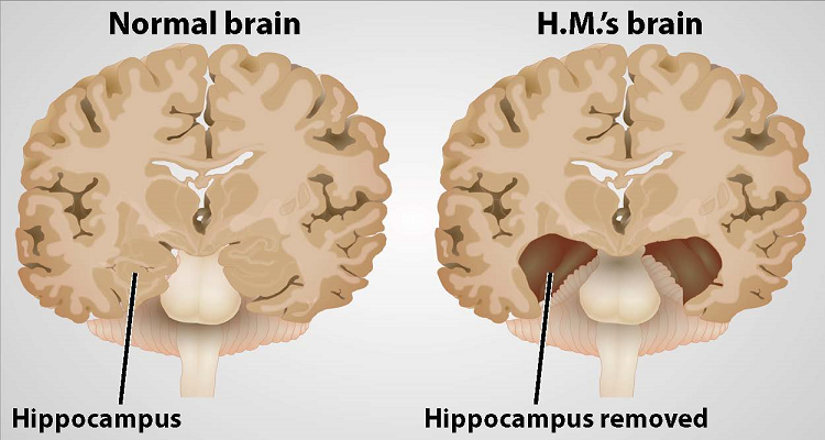 usporedba normalnog mozga i mozga pacijenta H. M. kojem je odstranjen hipokampus